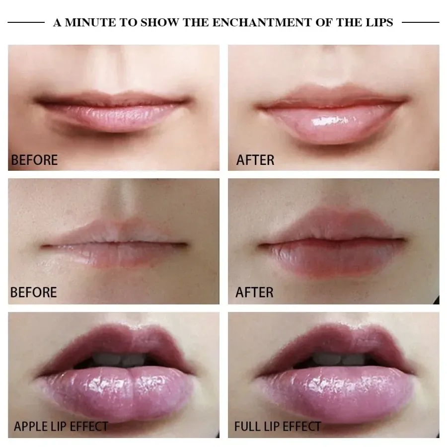 Lip Augmentation Device — photo 3