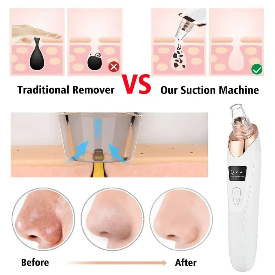 5 in 1 Rechargeable Blackhead Remover Facial Pore Cleaner Deep Cleaning β photo 6